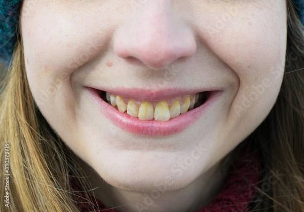 Fototapeta Yellow teeth of a girl, fluorosis. Smoker's problem teeth caused by fluoride, smoking, or coffee. Brown tooth enamel due to illness and drugs. Light skin and a wide smile. Natural photo