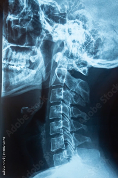 Fototapeta Cervical spine skeleton x-ray film of a patient with military neck or straight neck, medical concept photo