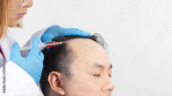 Fototapeta Close up of a bald man receiving injection in scalp from doctor. Man's head with gloves holding syringe on white background. Hair loss problem, alopecia treatment and hair growth concept.