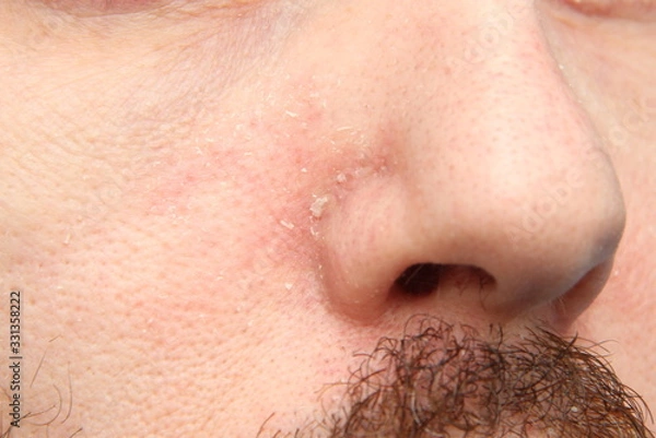 Fototapeta Part of the face with the nose of an adult white man with dry, flaky skin. Skin problems and diseases