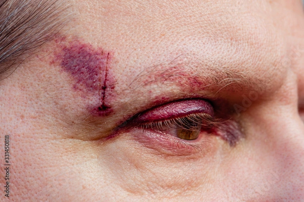 Fototapeta A white man with a purple black eye and head injury - eye open, side view