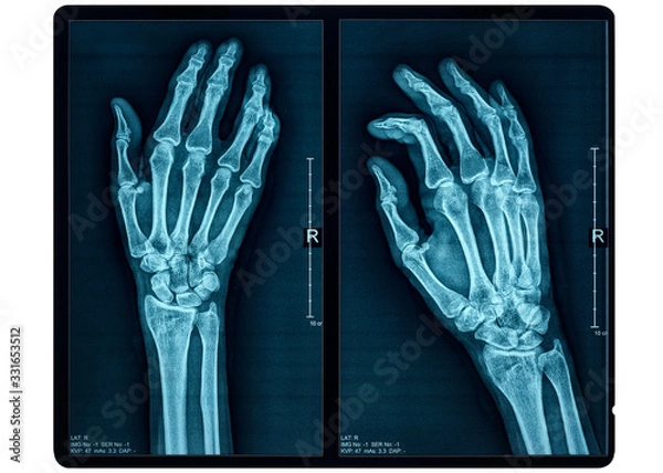 Fototapeta Hand X-ray
