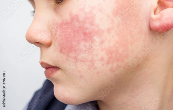 Fototapeta Boy with red cheeks- diathesis or allergy symptoms. Redness and peeling of the skin on the face. 
