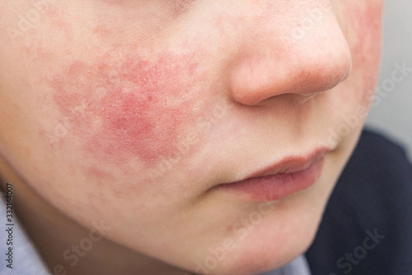 Obraz Boy with red cheeks- diathesis or allergy symptoms. Redness and peeling of the skin on the face. 