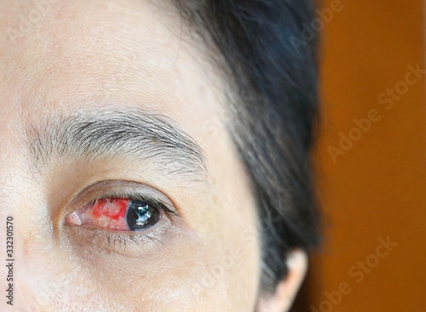Fototapeta Asian women have red eyes on the left side of the eye. Caused by broken capillaries in the eyes caused by the time when coughing or sneezing, the body pressure suddenly increases, high blood pressure