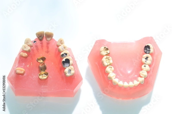 Obraz 補綴説明模型