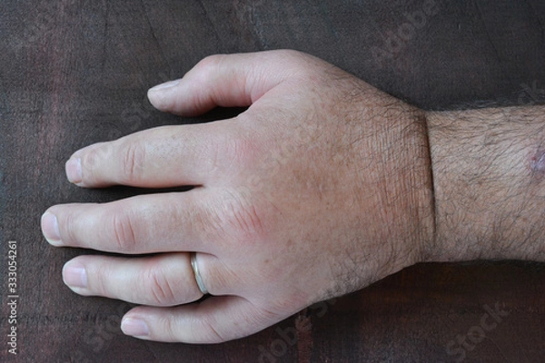 Fototapeta Swollen fist due to the sting of the wasp