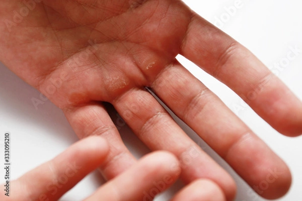 Obraz male hand with calluses in the palm