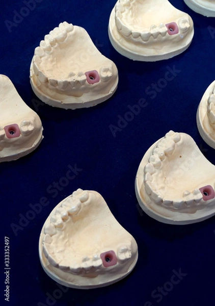 Fototapeta Closeup of dentures in the process of making false teeth