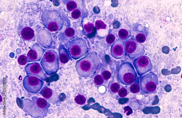 Fototapeta Multiple Myeloma Awareness: Bone marrow aspirate cytology of multiple myeloma, a type of bone marrow cancer of malignant plasma cells, associated with bone pain, bone  fractures and anemia.