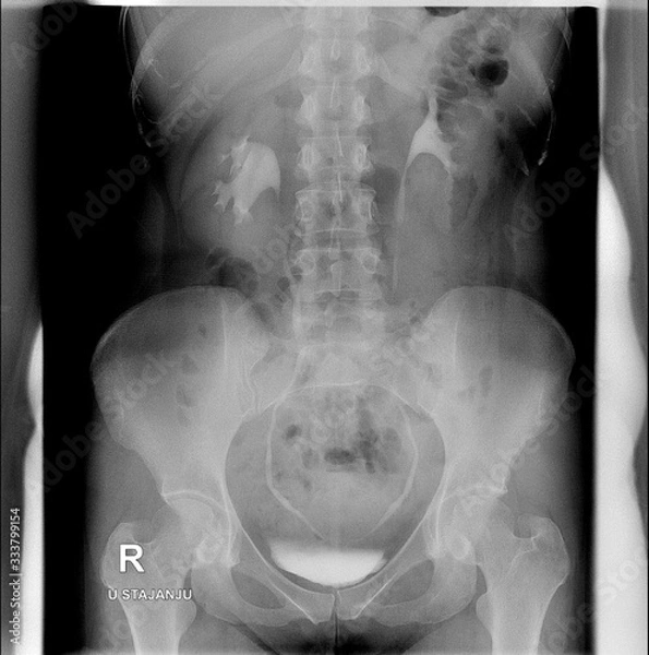 Obraz Intravenous urogram (IVU). Erect position. Ureters are without signs of narrowing, contrast agent passing down the ureters into the bladder with no filling defects within the ureters.