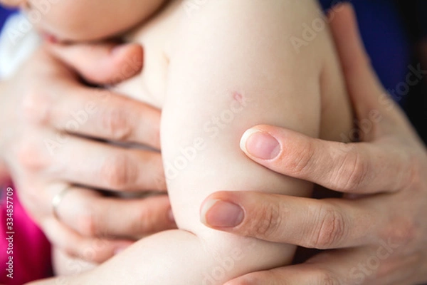 Fototapeta BCG vaccination mark is on infant shoulder, close up view with mother hands