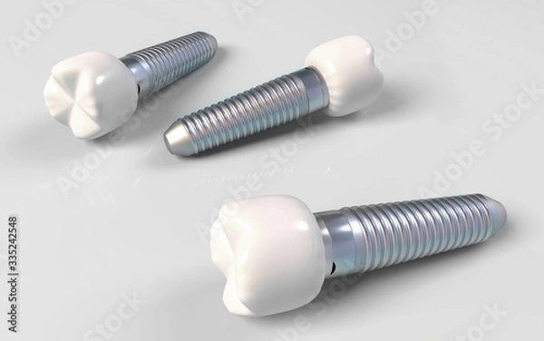 Obraz Dental implants illustration with white background