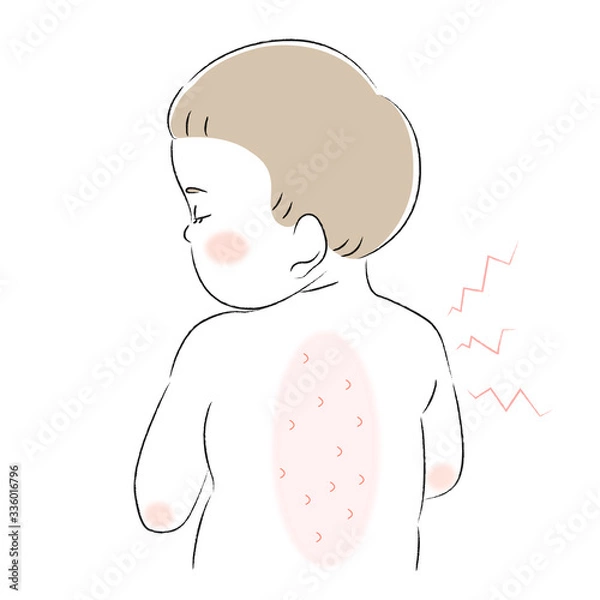 Fototapeta 背中　肌　悩み　痒み　子ども　幼児