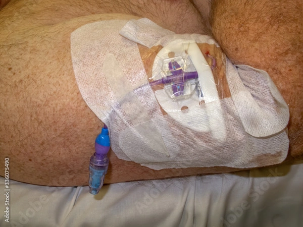 Fototapeta PICC line in arm of senior man in Cairns, Queensland, Austria