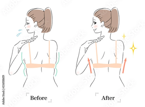 Fototapeta 背中　はみ肉　脂肪　ビフォーアフター　女性