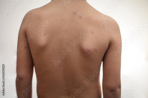 Obraz Impaired immunity brings about various diseases.