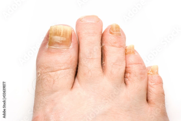 Obraz Toenail Fungus