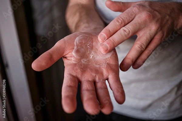 Fototapeta Man putting moisturizer onto his hand with very dry skin and deep cracks with cream due to washing alcohol on Covid19 situation. Horizontal close up of the inside of a very sore dry cracked male hand
