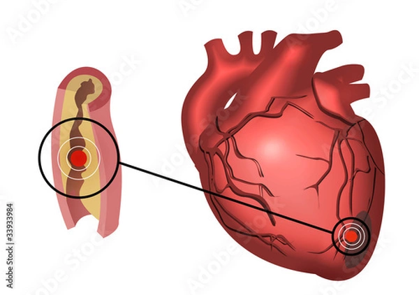 Fototapeta Infarto