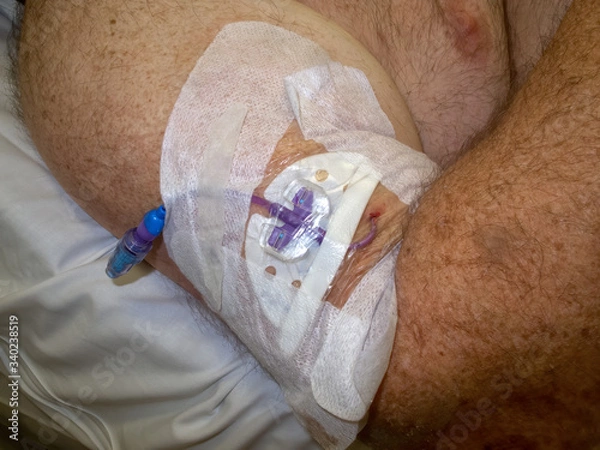 Fototapeta PICC line in arm of senior man in Cairns, Queensland, Austria