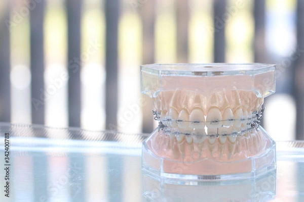 Obraz ブラケット付き歯列模型