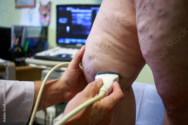 Obraz The varicose veins