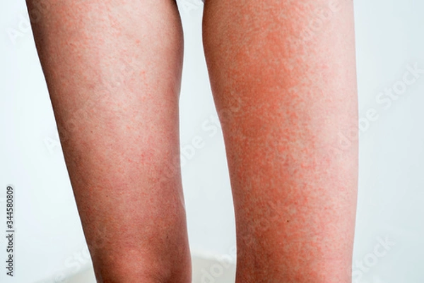 Obraz Severe sunburn, summer tan, poor sun protection. Sun allergies, obstruction, itching pain and blisters on the skin of the legs.