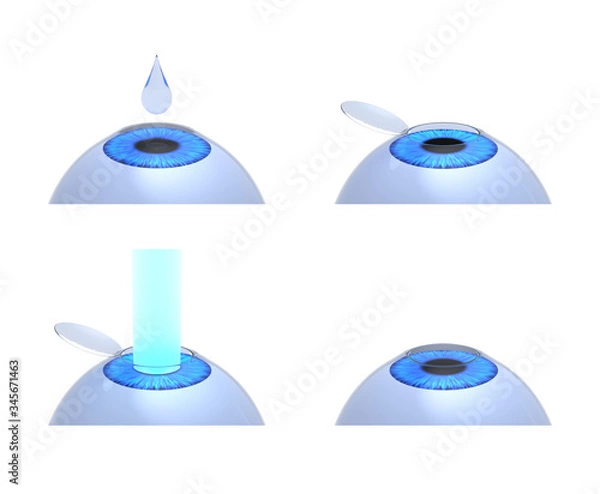Fototapeta Laser eye surgery procedure. 3D-rendering.