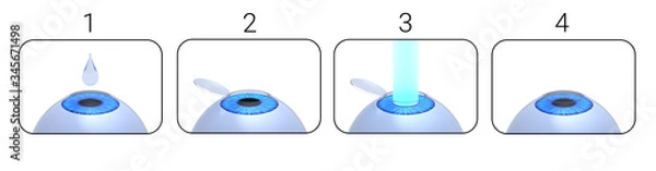 Fototapeta Laser eye surgery procedure. 3D-rendering.