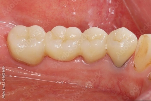 Fototapeta セラミックブリッジ