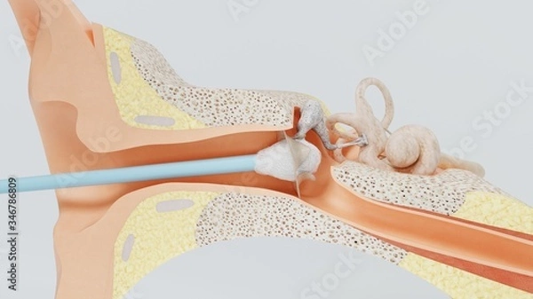Fototapeta 3d render ear cleansing ear stick. cleansing earwax with an ear stick