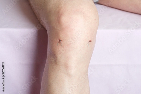 Fototapeta Arthroscopy or arthroscopic meniscectomy surgical suture of a man's knee in the hospital
