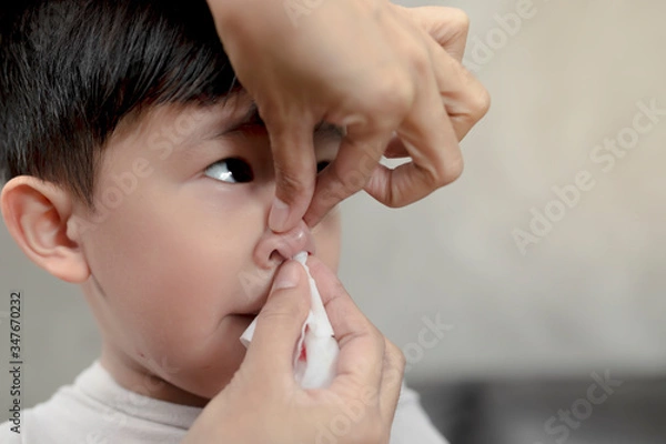 Obraz Portrait of cute Asian ethnic child having nosebleed,The concept of first aid for nosebleeds.