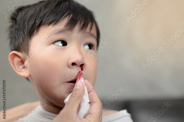 Obraz Portrait of cute Asian ethnic child having nosebleed,The concept of first aid for nosebleeds.