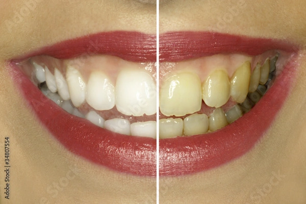 Fototapeta Zähne vor und nach dem Bleaching