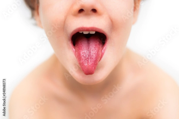 Obraz Tongue and mouth of a child during scarlet fever