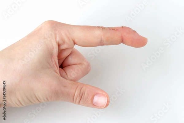 Obraz a cut index finger with a extensor tendon injury, mallet finger, tip of finger bending downwards the rest of the finger stay straight, deformity in the last phalangeal bone, pointing wrong direction
