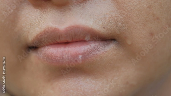 Fototapeta 
Sweating on the lips and face of women.