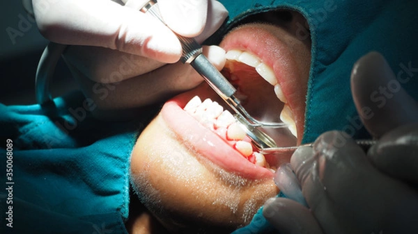 Obraz Dentists are treating gingivitis by scaling.