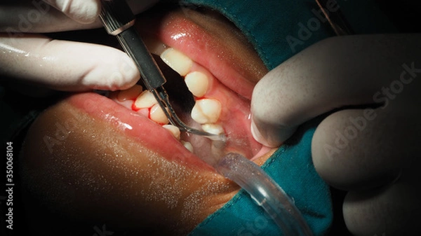 Obraz Dentists are treating gingivitis by scaling.