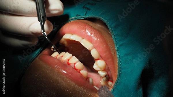 Obraz Dentists are treating gingivitis by scaling.