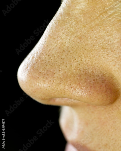 Obraz Nose Blackheads