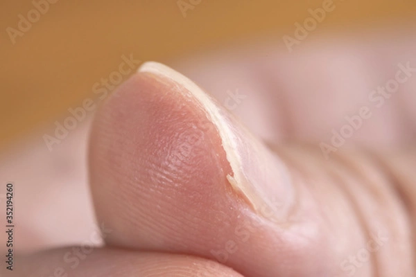 Fototapeta 手の親指の巻き爪
