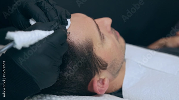 Fototapeta High quality close-up of a man laying on a couch during the esthetician hair treatment. Male tricopigmentation service. Scalp micropigmentation treatment. Trichopigmentation procedure.