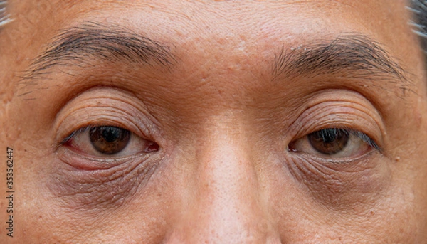 Fototapeta Skin face problem of asian man 40s, age  .Middle aged man has under eye dark circles