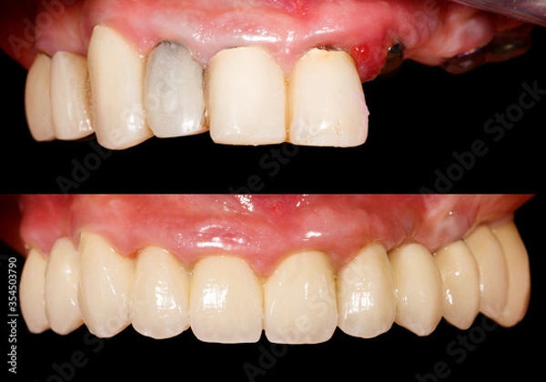Obraz Teeth before and after treatment
