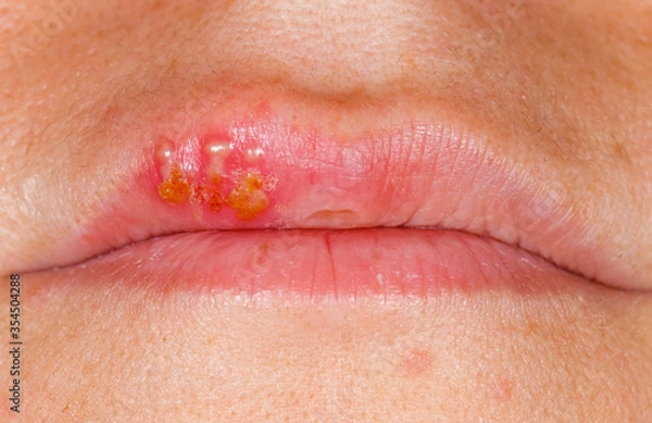 Obraz Oral herpes simplex virus infection