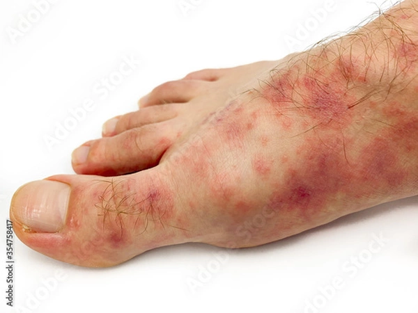 Fototapeta Close up of male's covid foot and toes with red rash desease isolated on a white background.