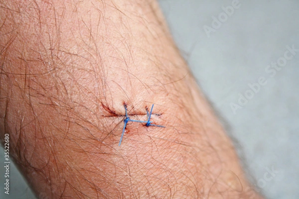 Obraz arm after a biopsy